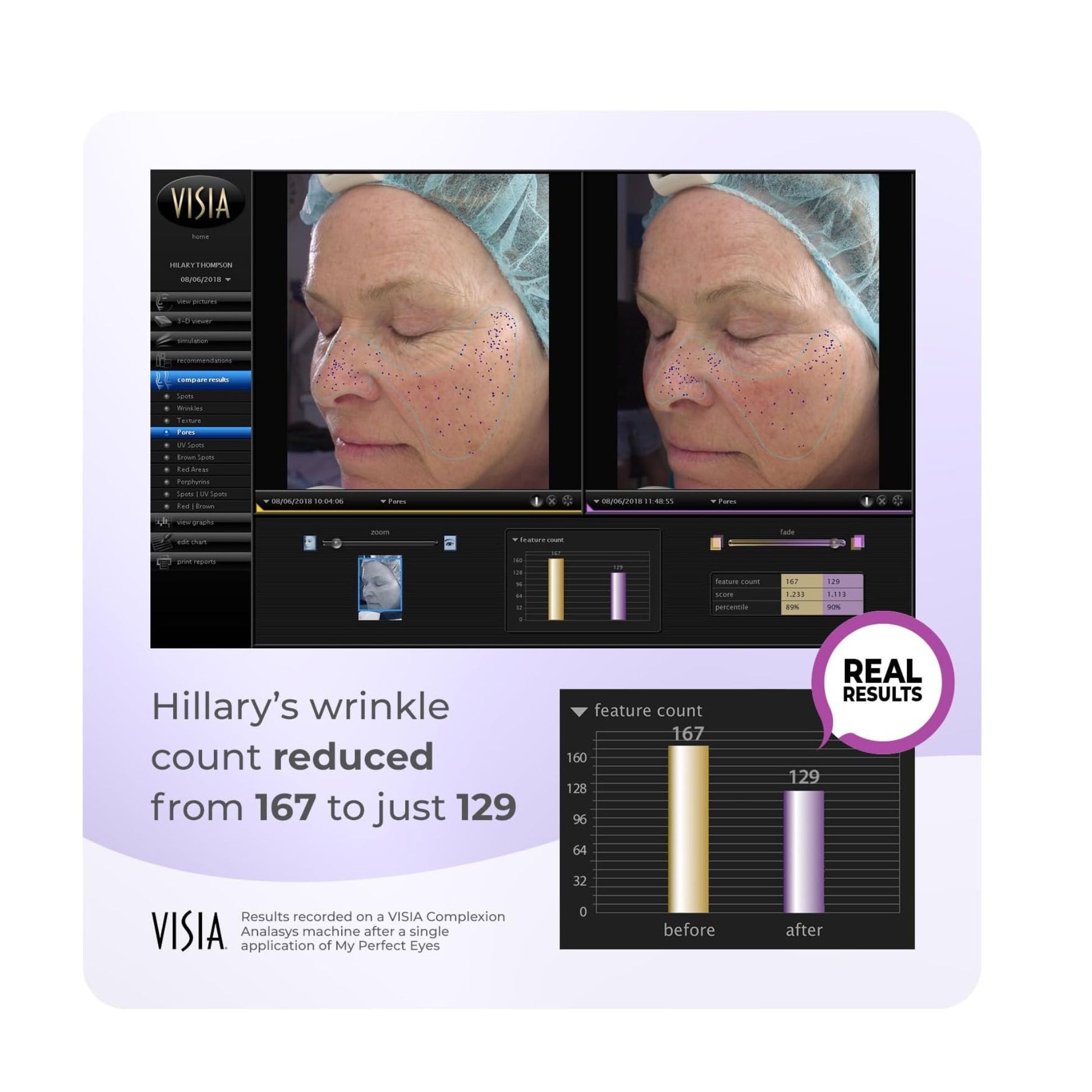 My Perfect Facial, Penny Lane, 5 Treatment Kit, Instant Results, Clinically Proven, Anti-Ageing 3-Stage Facial Contouring and Skin Tightening System. Salon Grade Results, 20 minute facial at home Real results